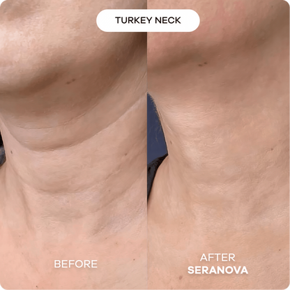 Seranova Micro Infusion Hyaluronic Acid Collagen Peptide 3 Month Supply